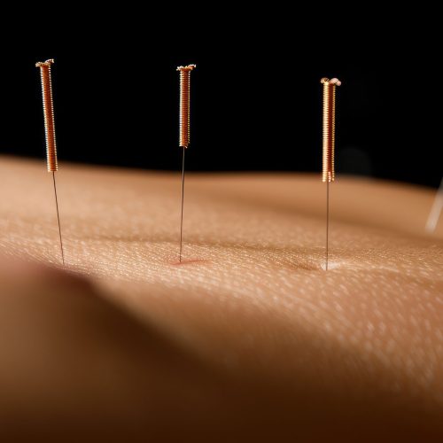 Acupuncture Therapy: A close-up of acupuncture needles being carefully placed on a patient’s back in a tranquil clinic --chaos 80 --ar 2:1 --stylize 500 --v 6 Job ID: ad5ce18d-02f7-4c34-93f2-ab3f290769e7
