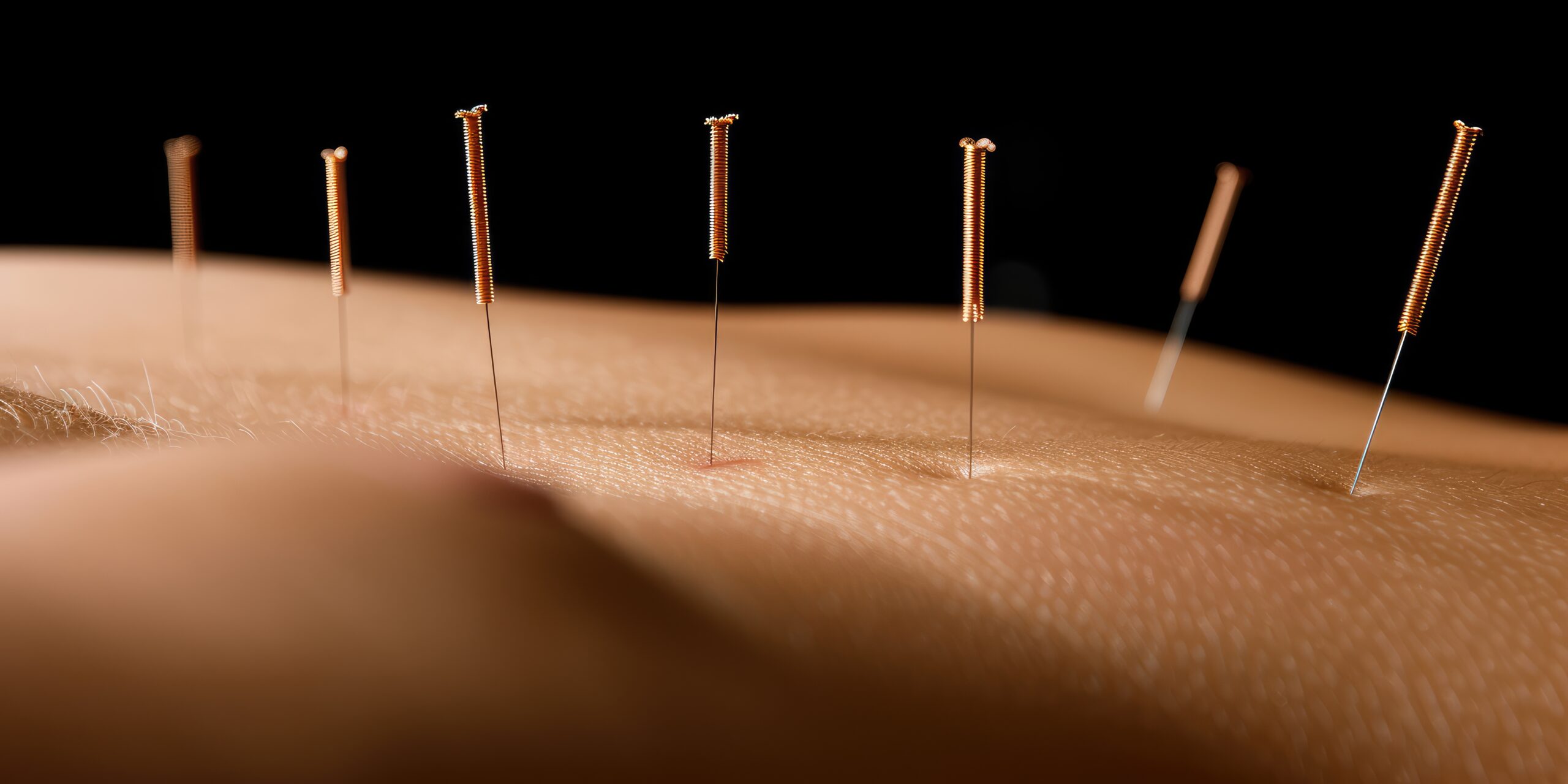 Acupuncture Therapy: A close-up of acupuncture needles being carefully placed on a patient’s back in a tranquil clinic --chaos 80 --ar 2:1 --stylize 500 --v 6 Job ID: ad5ce18d-02f7-4c34-93f2-ab3f290769e7